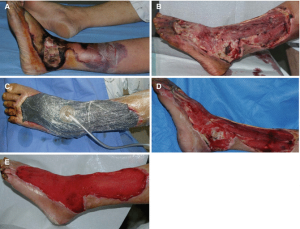 وکیوم تراپی