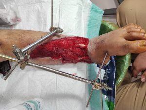 وکیوم تراپی