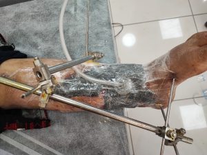 وکیوم تراپی