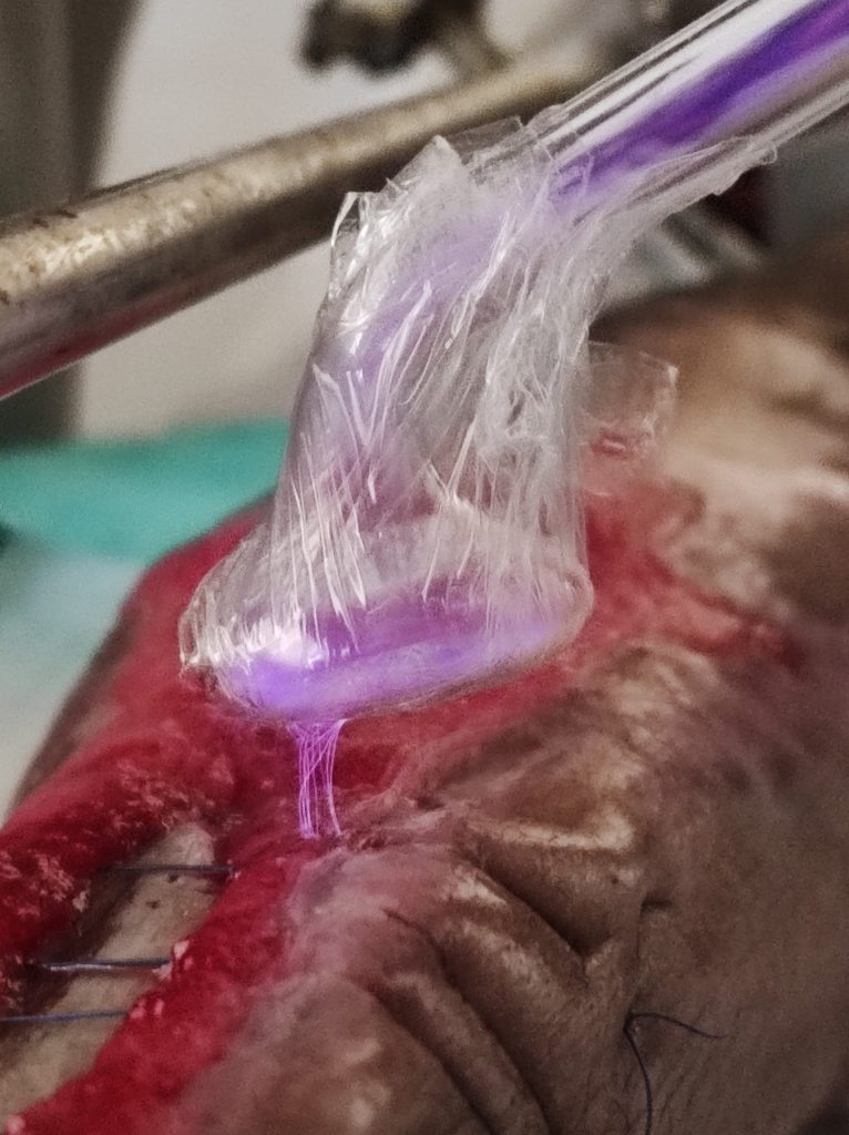 پلاسما تراپی