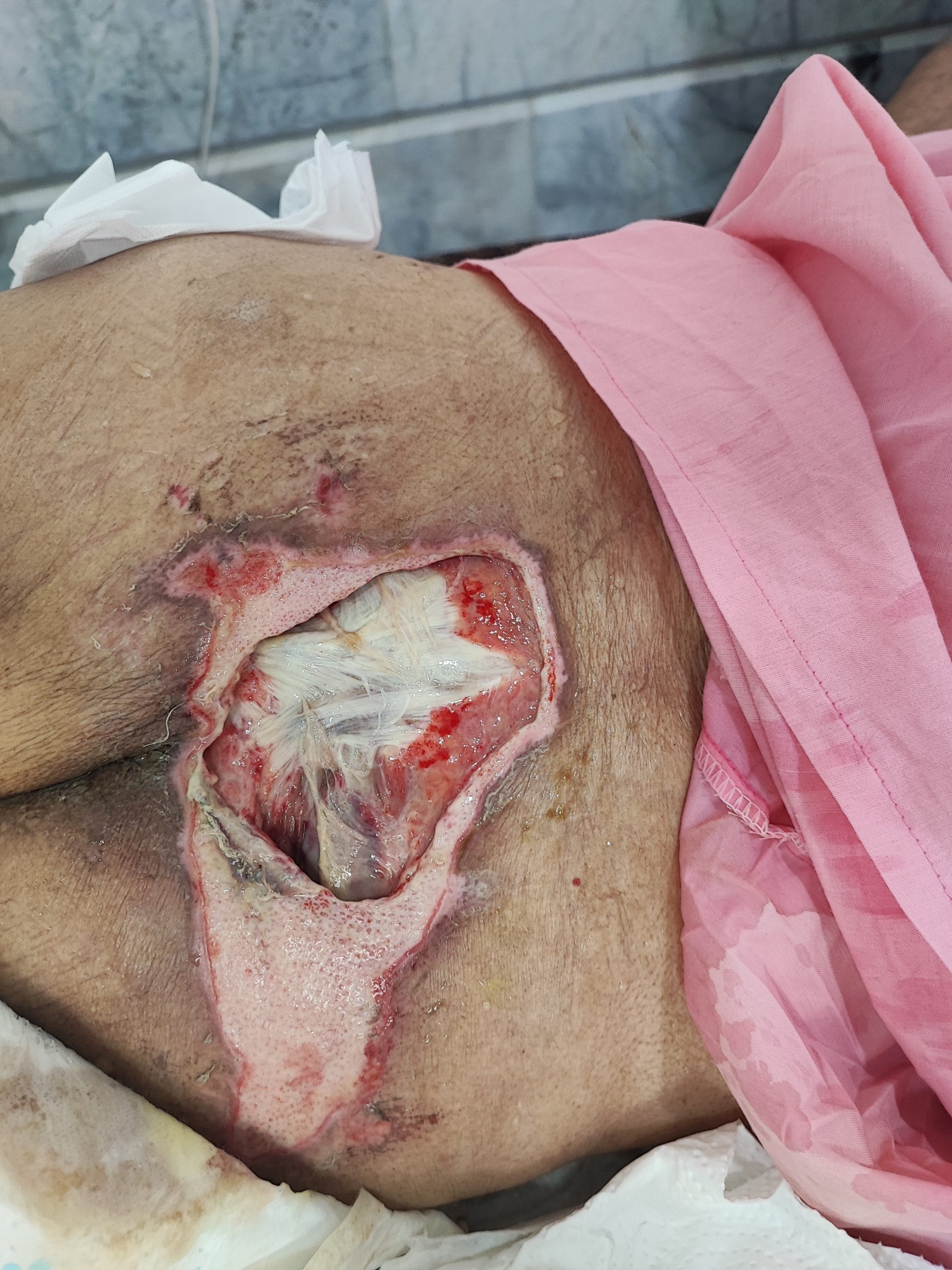 زخم بستر-زخم فشاری زخم بستر درجه ۴