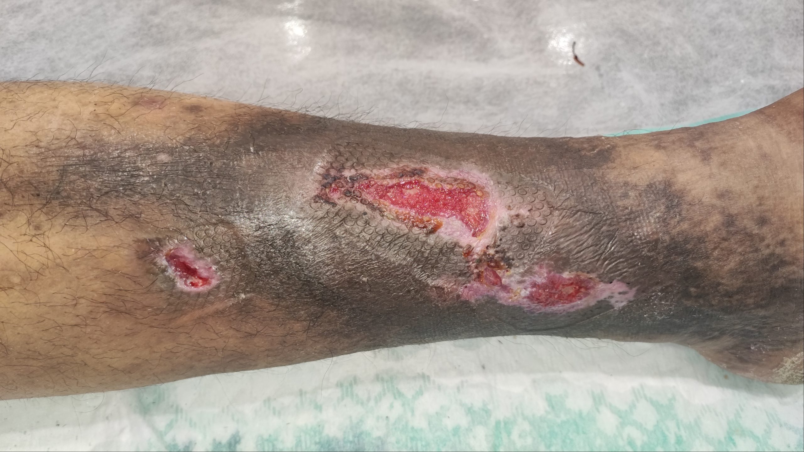 زخم های عروق زخم وریدی زخم های عروق