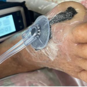 وکیوم تراپی 