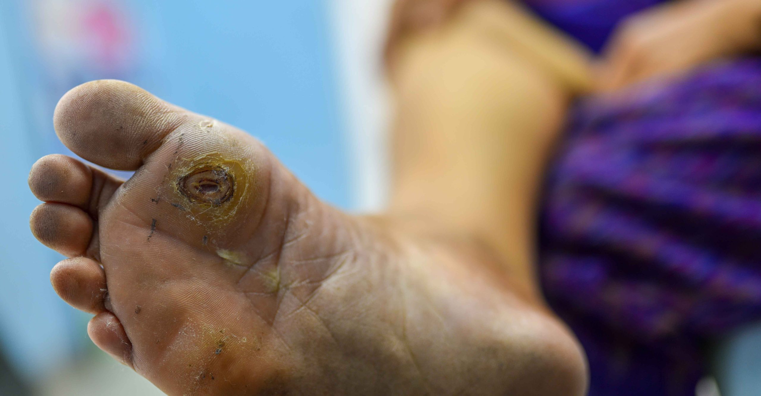 زخم های دیابتی