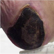 زخم بستر-زخم فشاری زخم فشاری