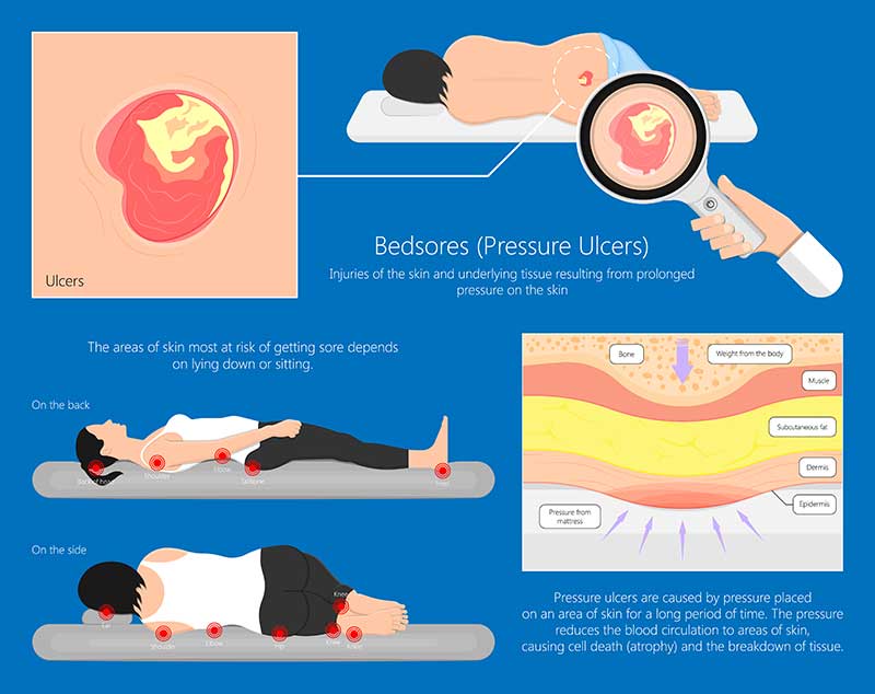 زخم بستر-زخم فشاری