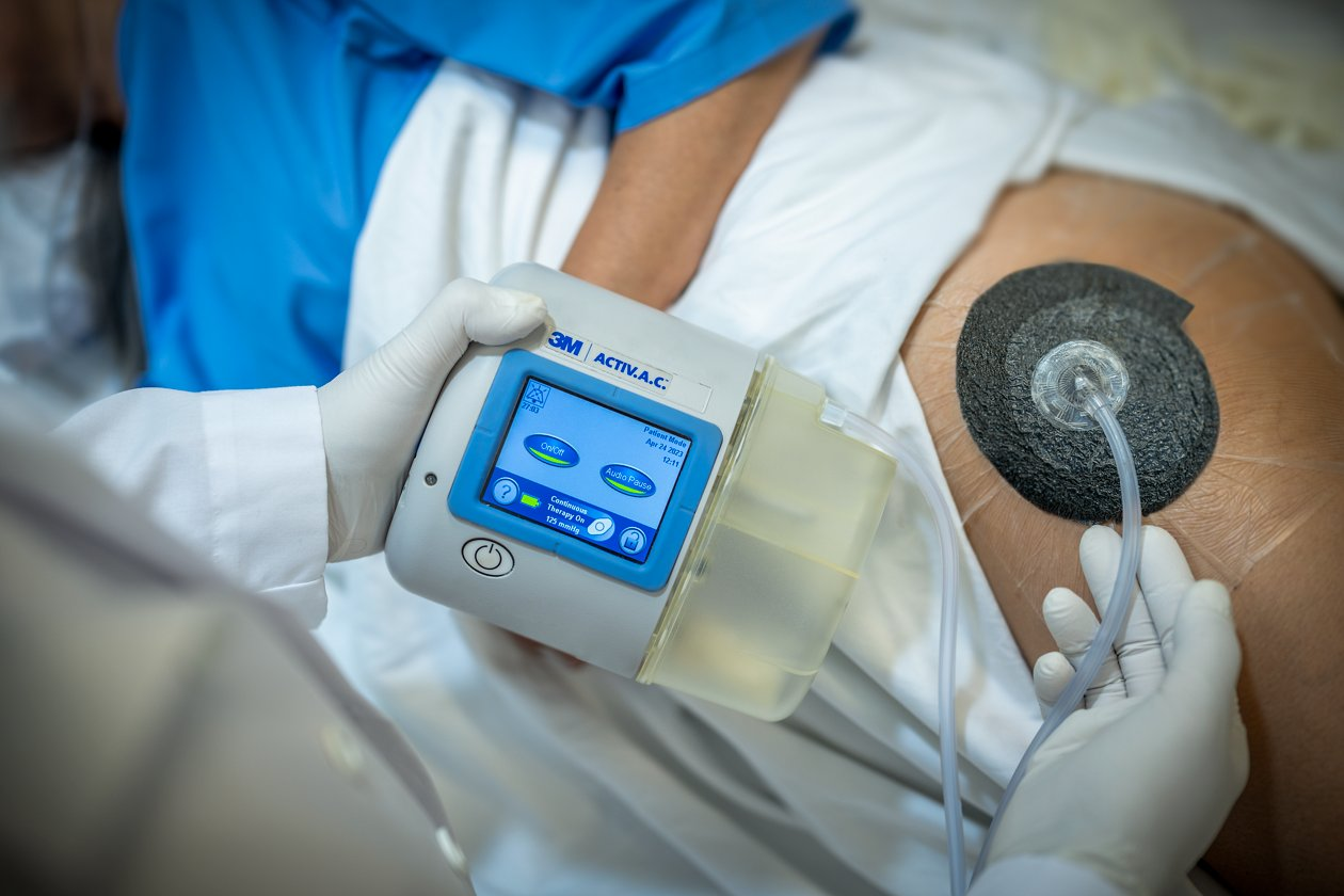 وکیوم تراپی