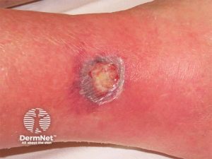 زخم های عروق زخم های عروق