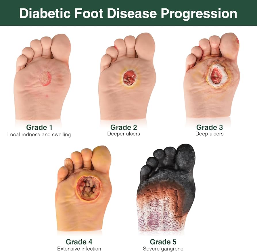 درجه بندی زخم دیابت