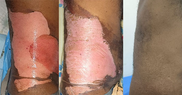 مراحل ترمیم زخم سوختگی